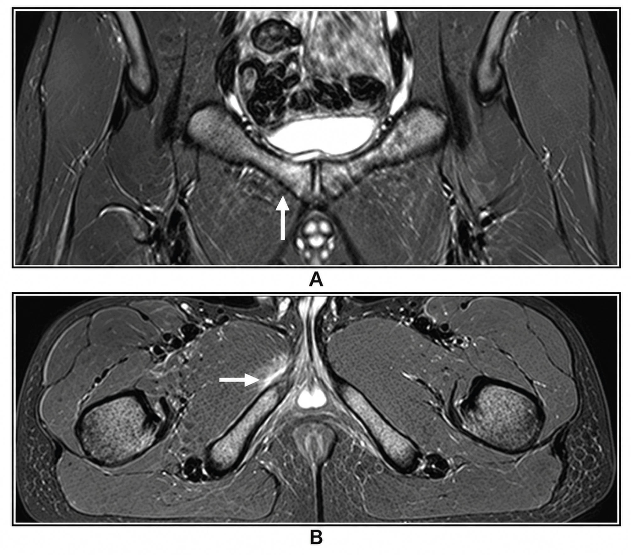 Figure 1. Coronal (A) and axial (B) magnetic resonance images demonstrate bone marrow oedema in the pubic bone (white arrow) and surrounding soft tissues (black arrow) on the right side