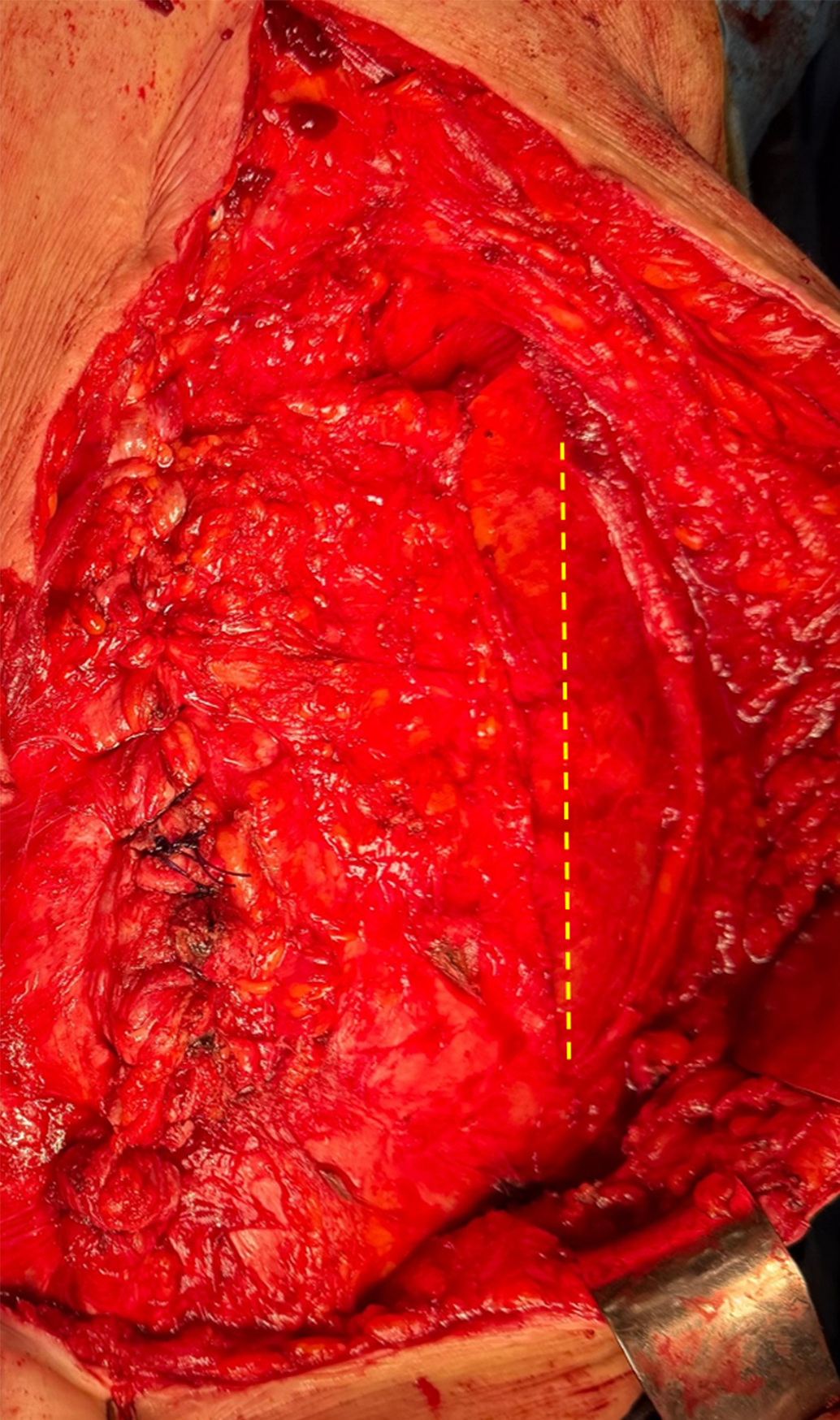 Figure 1. Anterior component separation (Ant. CS): lateral relaxation incision