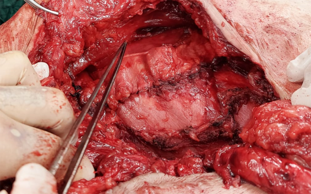 Figure 2. Transversus abdominis release (TAR)