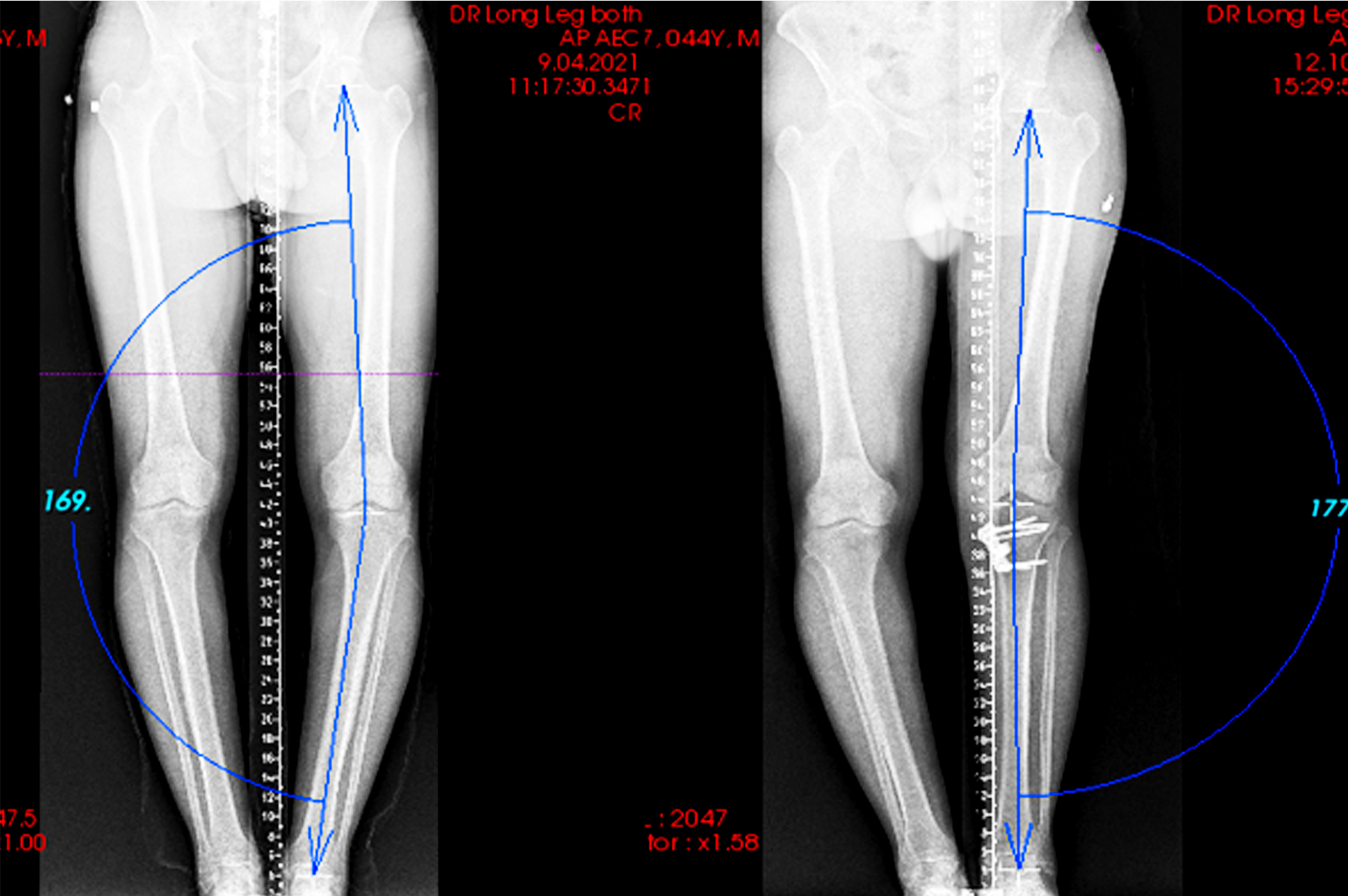 Figure 1. Preoperative and postoperative hip–knee–ankle (HKA) angle measurements