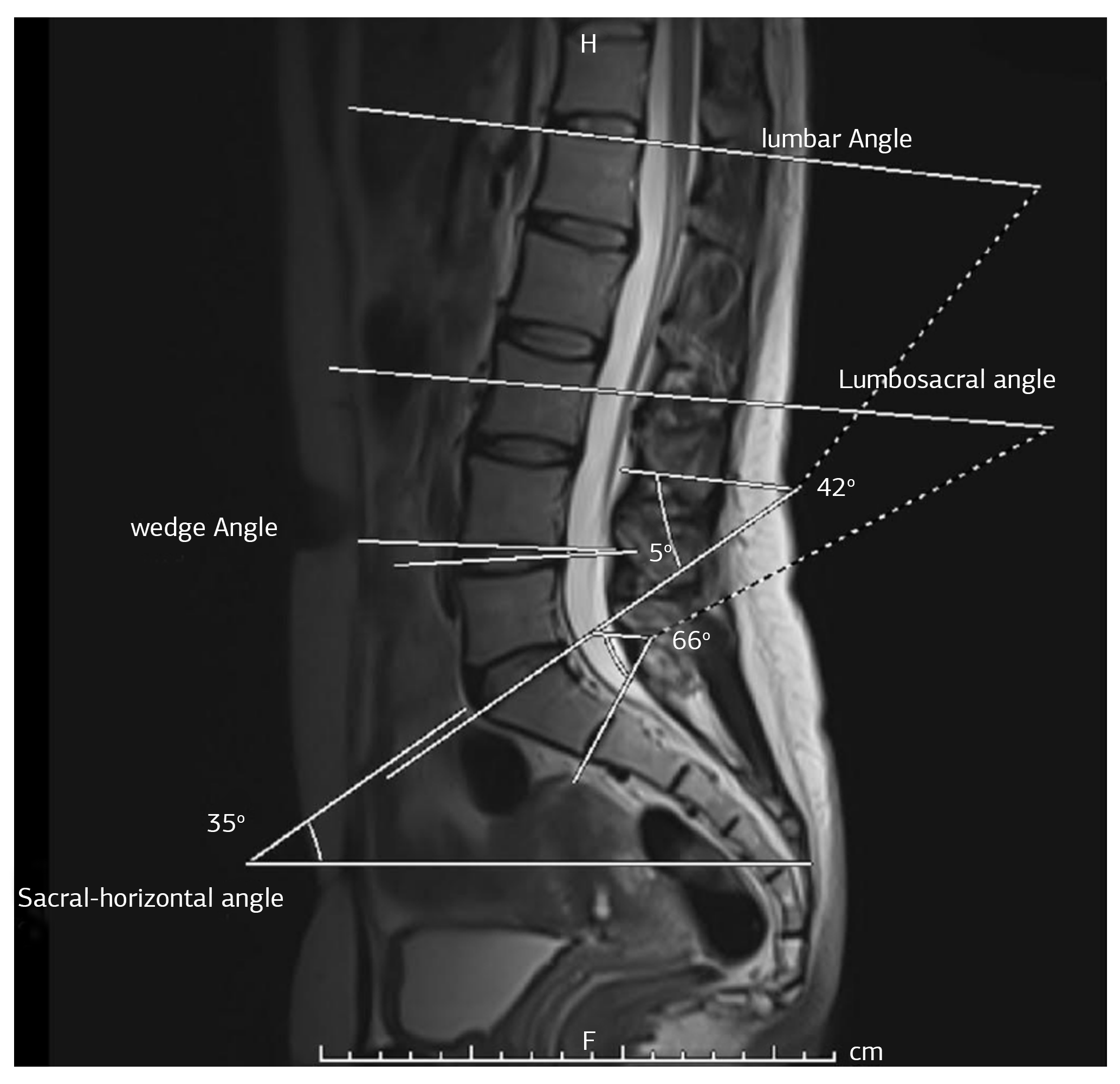 Figure 1. Measurements of lumbar angle, lumbosacral angle, wedge angle, and sacral horizontal angle of a patient MRI images