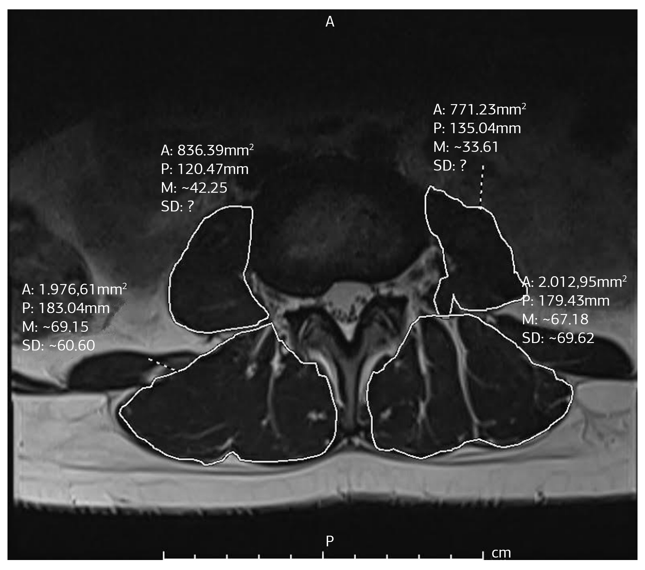 Figure 2. Measurements of the right and left PSOAS muscle volumes and the right and left lumbar extensor muscles of a patient on T2 weighted axial plane MRI