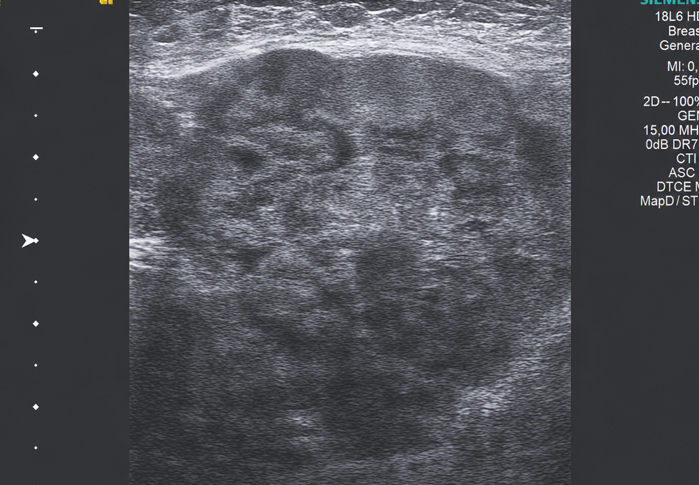 Figure 1. Ultrasonographic image of the recurrent mass that developed on the patient’s anterior chest wall 7 months after surgery. A hypoechoic mass lesion with a heterogeneous internal structure and regular lobulated contours measuring approximately 60x50 mm at its widest portion, not fitting into the probe area on the left anterior chest wall in the ultrasonography image. The biopsy result was evaluated as grade 3 metaplastic carcinoma. (ER 11-20%, PR 11-20%, HER (-), p53 and “wild type”, GATA-3 focal (+), CK5/6 (+), Ki-67 20%)