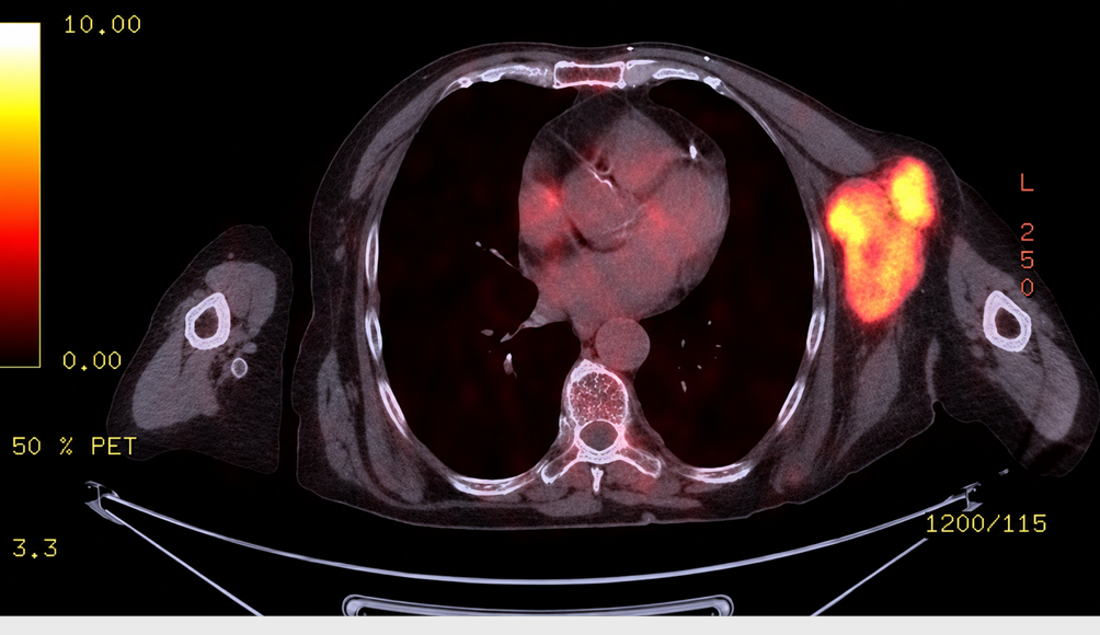Figure 2. PET-CT (July 2024) image of the patient. Multiple hypermetabolic lymph nodes with a conglomerated appearance were seen in the left axilla