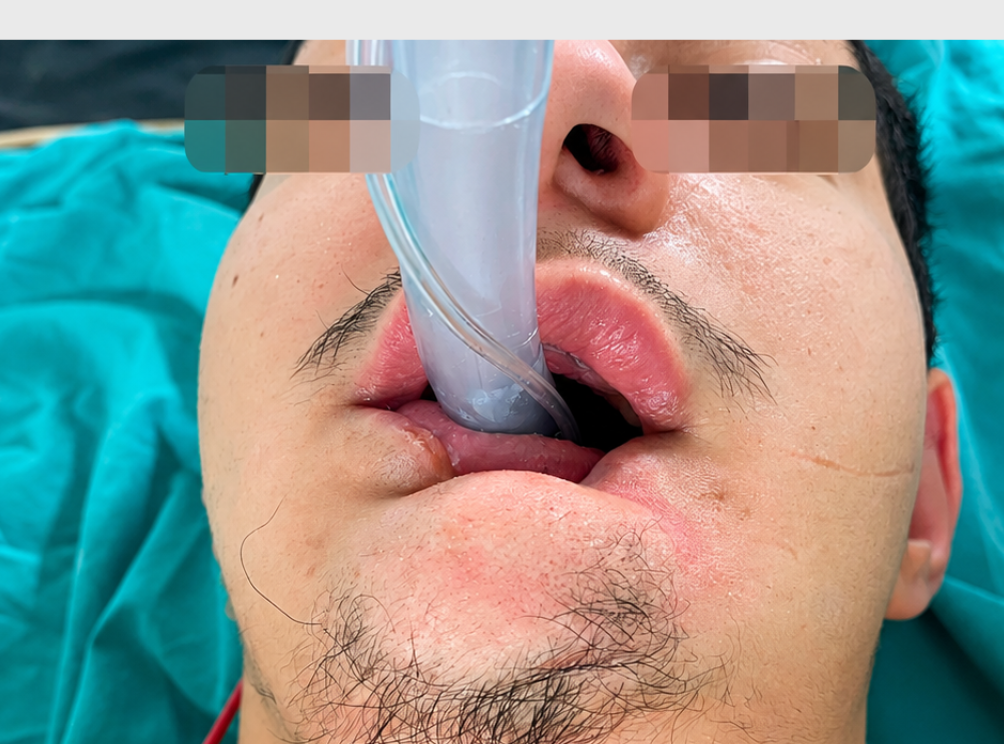 Figure 1. Persistent chewing leading to lip atrophy