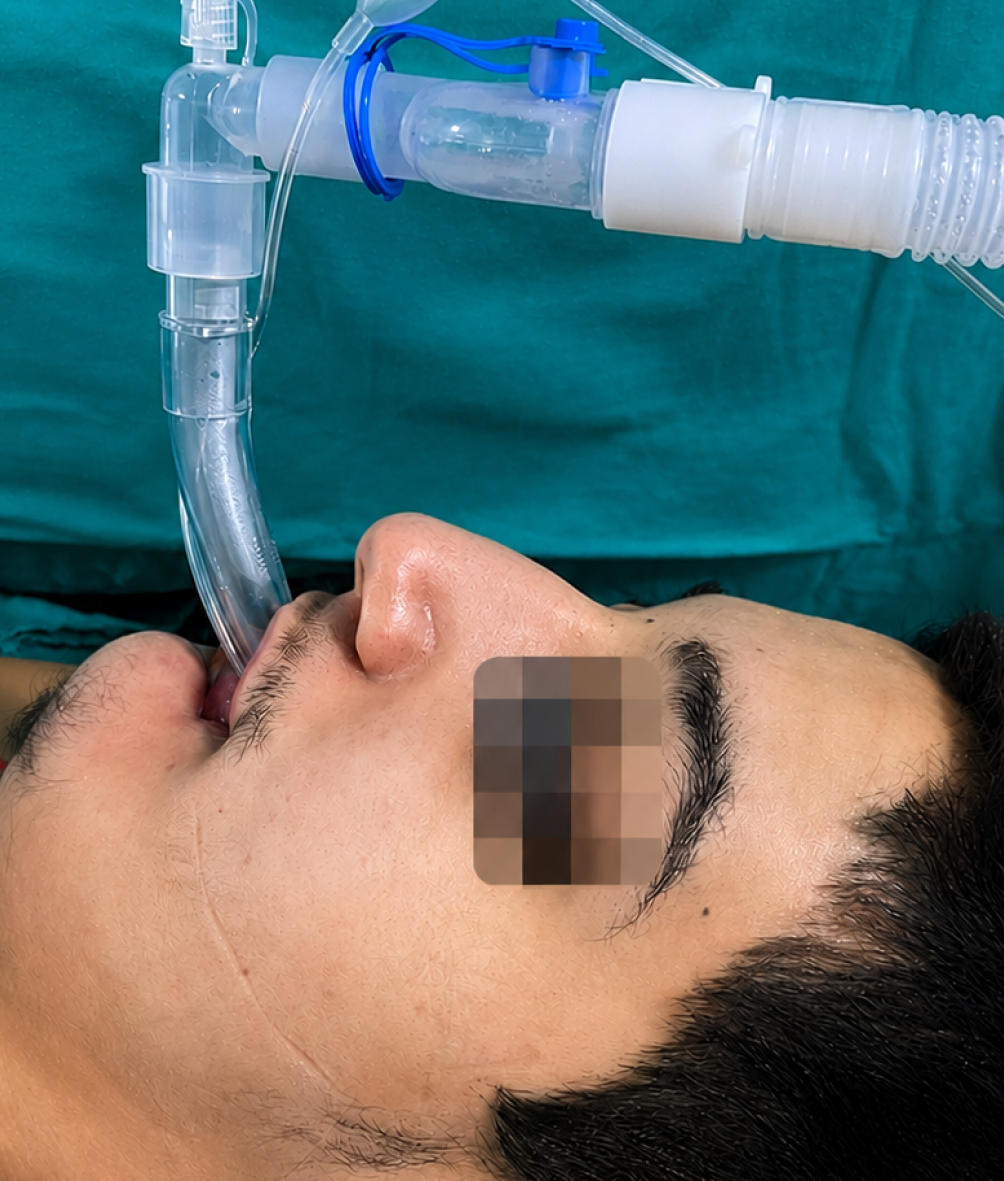 Figure 2. Atrophy of the lower lip due to persistent chewing