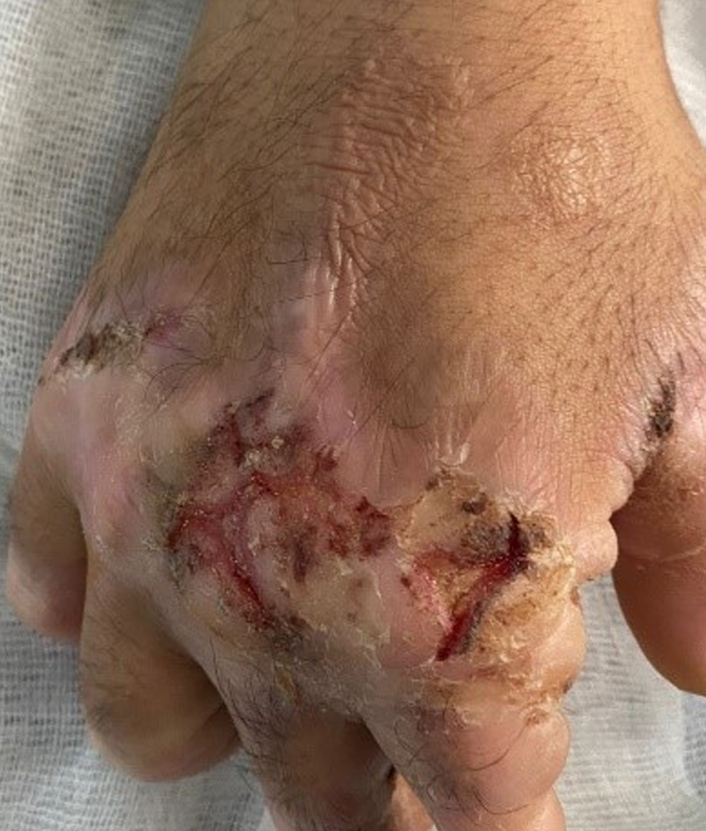 Figure 3. Abnormalities on the dorsal surfaces and digits of both hands
