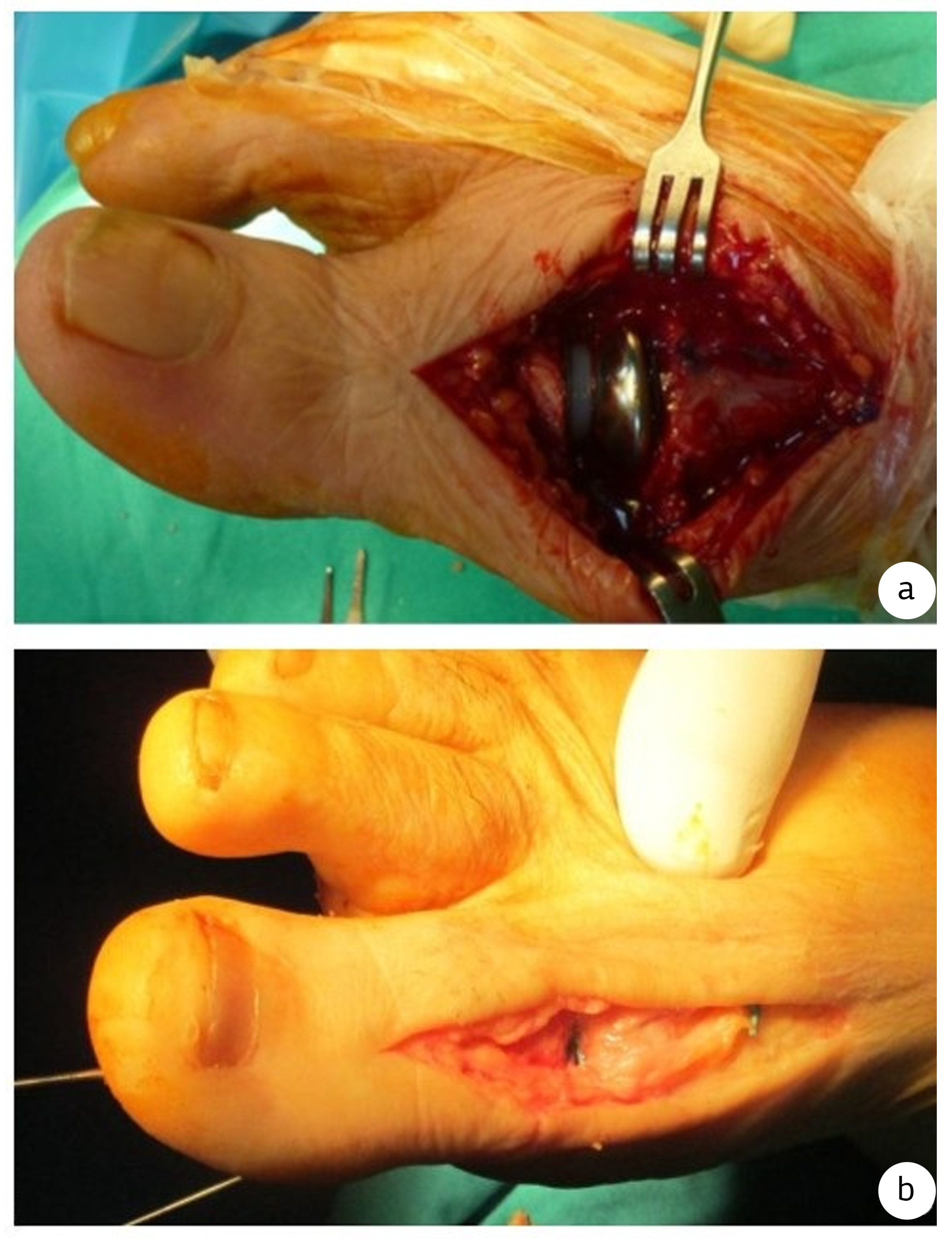 Figure 1. Intraoperative surgical procedure images a: implant arthroplasty b: resection interposition arthroplasty