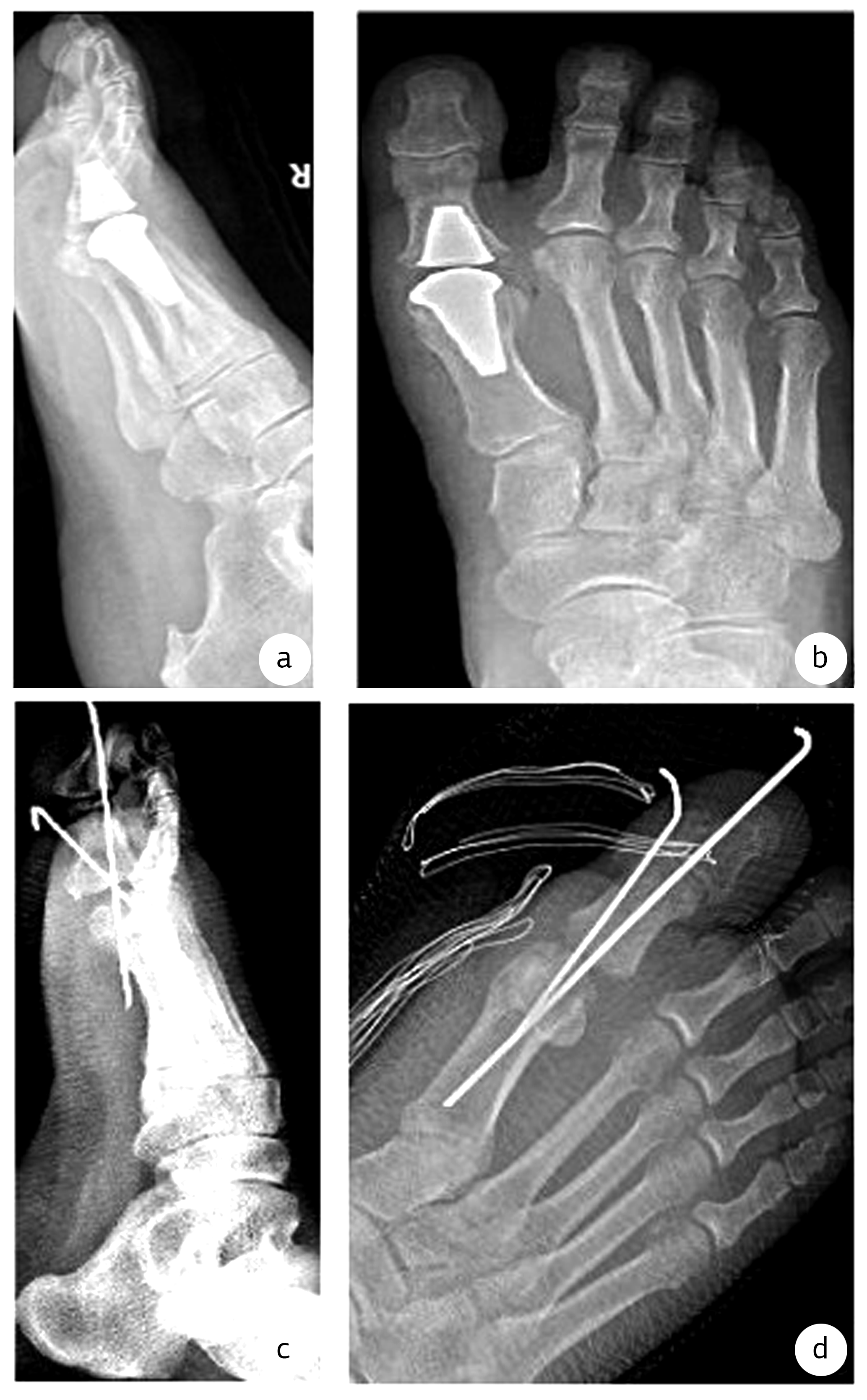 Figure 2. Postoperative x-ray images of surgical procedures a, b: implant arthroplasty c, d: resection interposition arthroplasty